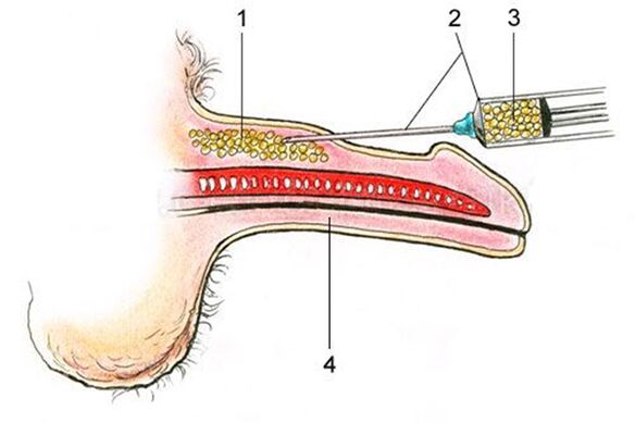 Lipofilling - the insertion of fatty tissue into the shaft of the penis