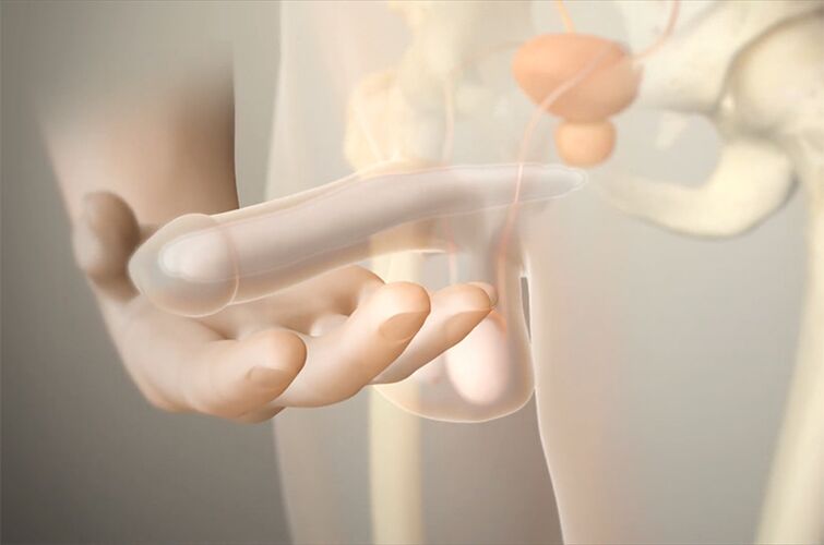 Gel implants to increase a member