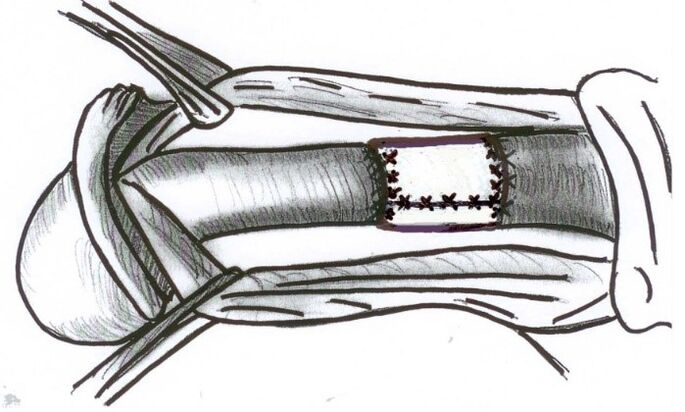 Installation of a collagen matrix to increase a member