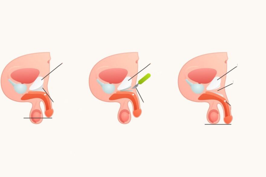 Ligamentotomy to increase the penis
