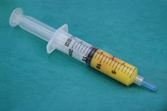 Syringe with fatty tissue for lipofilling