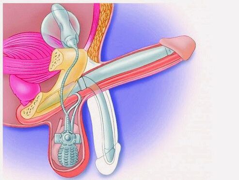 Penis enlargement through penile prosthesis